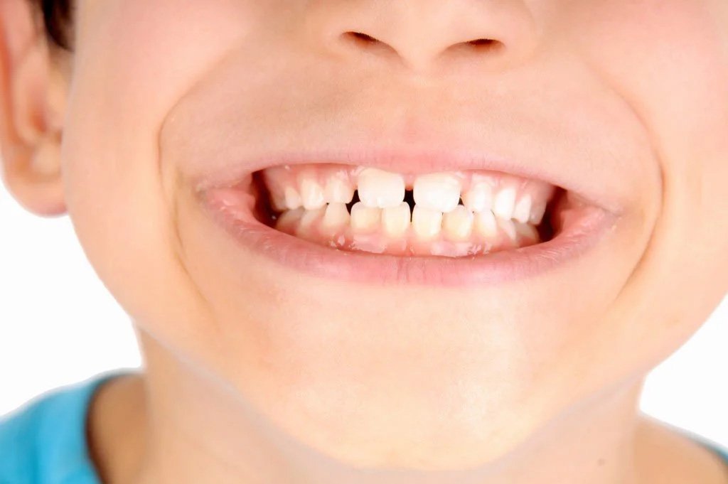 Sulfato Ferroso x Mancha nos Dentes